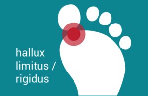 hallux-limitus-rigidus